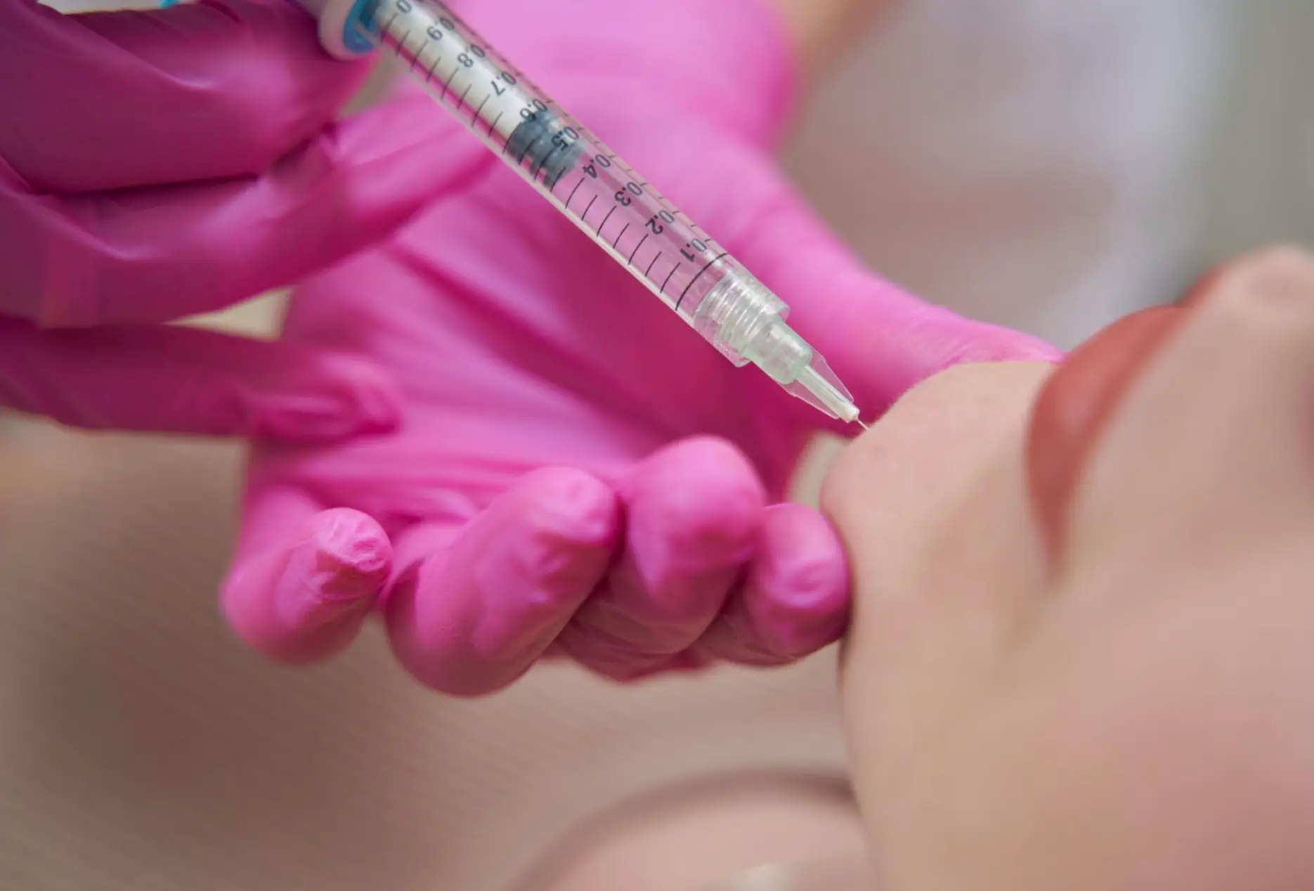 Dermal Fillers